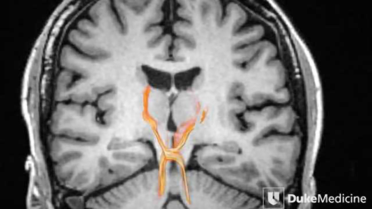 MRI technology reveals deep brain pathways in unprecedented detail