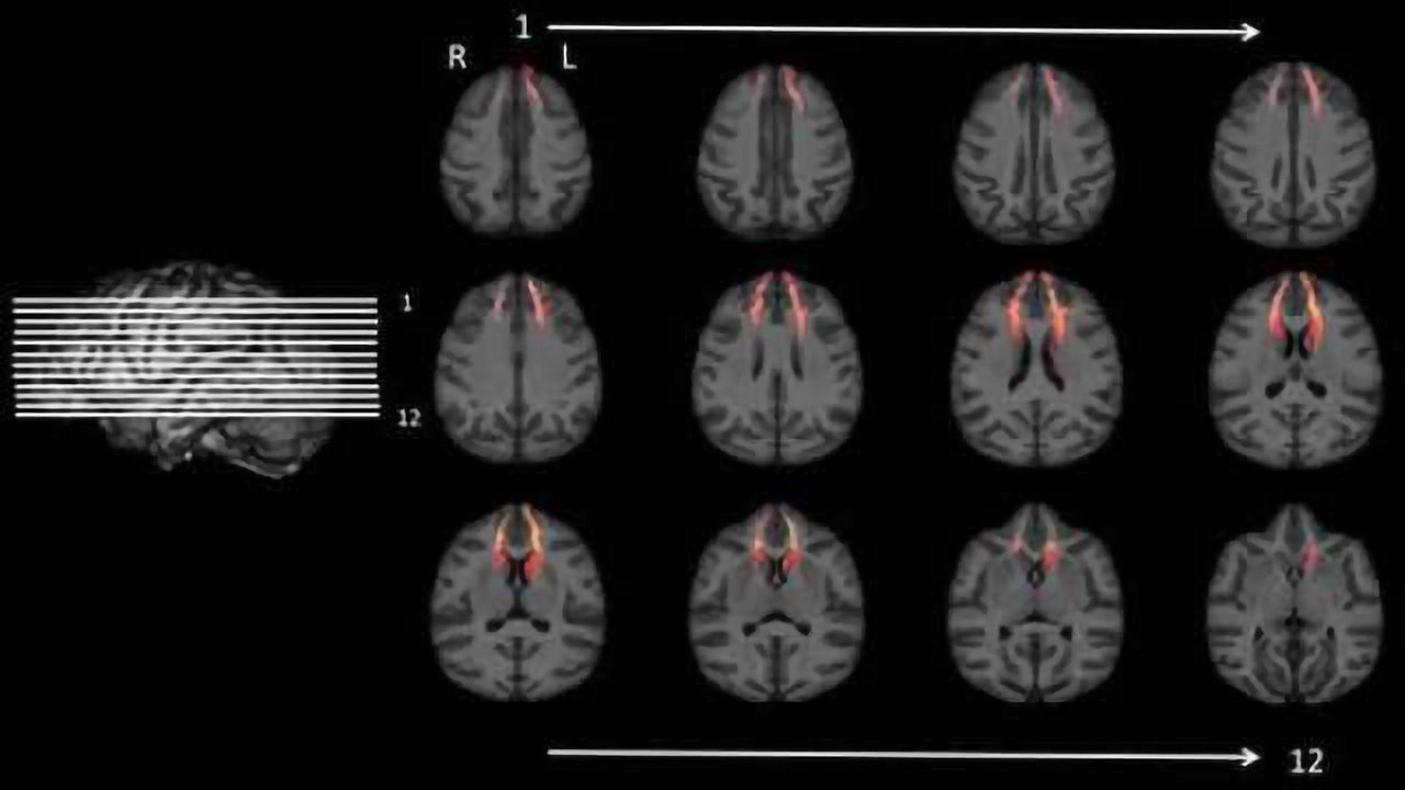 Study links delay of gratification to how brain structures are connected