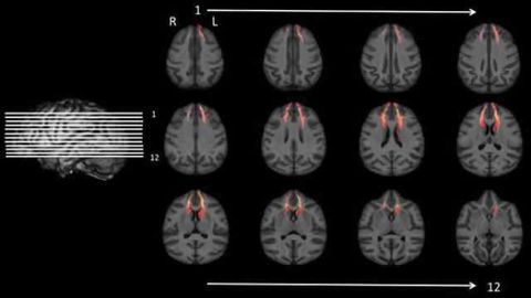 Study links delay of gratification to how brain structures are connected