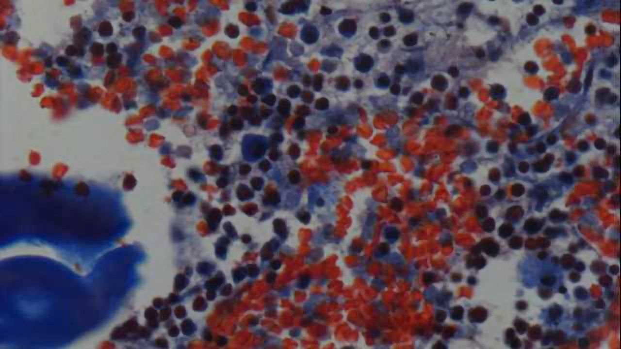 Autologous stem cell therapy is helpful in traumatic brain injury