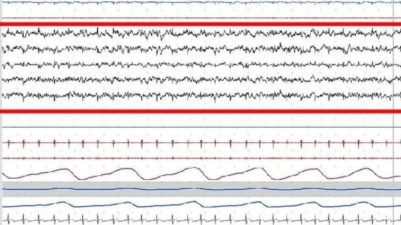 Sleep in a dish: Researchers isolate smallest unit of sleep to date