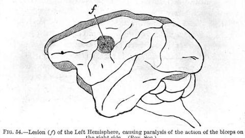 Brain lesions in children challenging to diagnose