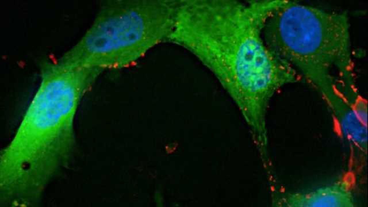 Scientists find way to disrupt brain tumor stem cells