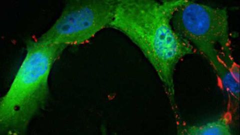 Scientists find way to disrupt brain tumor stem cells