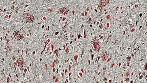 Multiple pathways progressing to Alzheimer’s disease