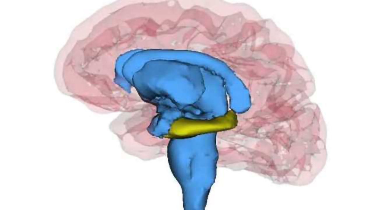 Patients with recurrent depression have smaller hippocampi