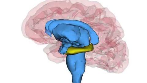 Patients with recurrent depression have smaller hippocampi