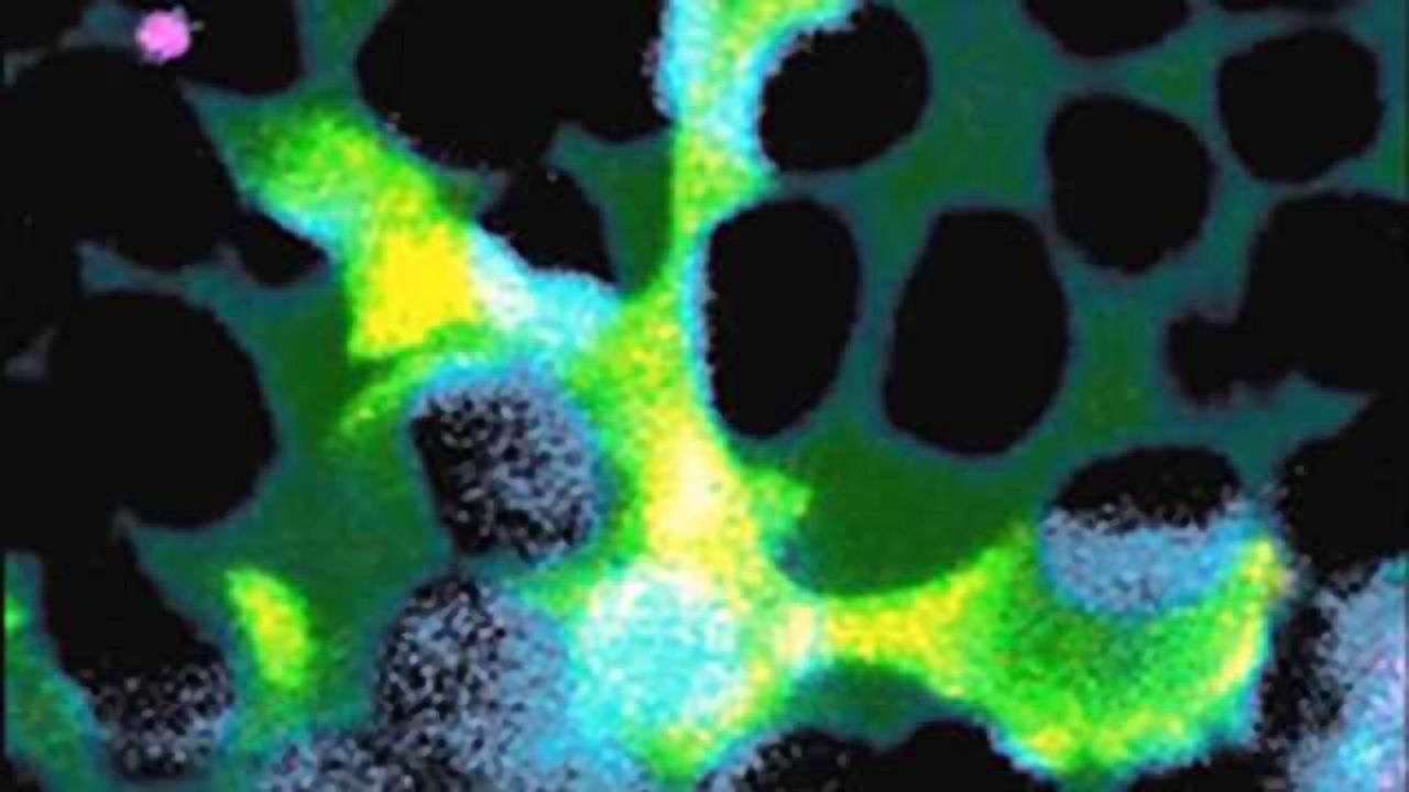 In blinding eye disease, trash-collecting cells go awry, accelerate damage
