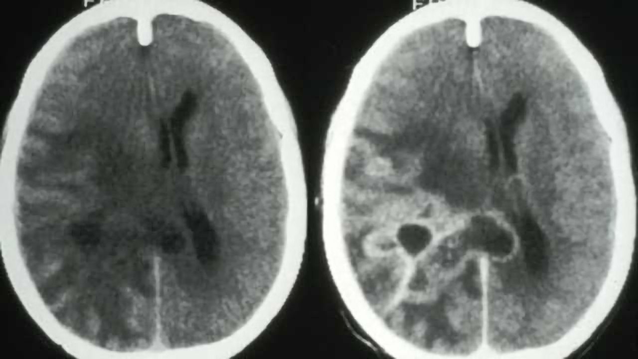 Improved survival in adult patients with low-grade brain tumors