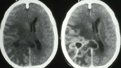 Improved survival in adult patients with low-grade brain tumors