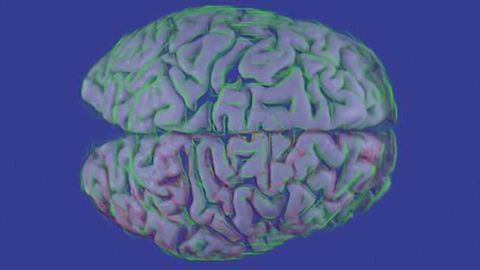 Researchers identify brain abnormalities in people with schizophrenia