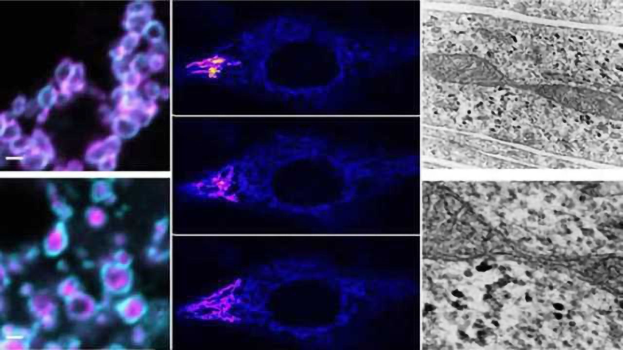 Researchers identify a novel disease gene causing neurodegenerative disorders