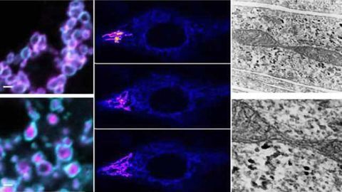 Researchers identify a novel disease gene causing neurodegenerative disorders