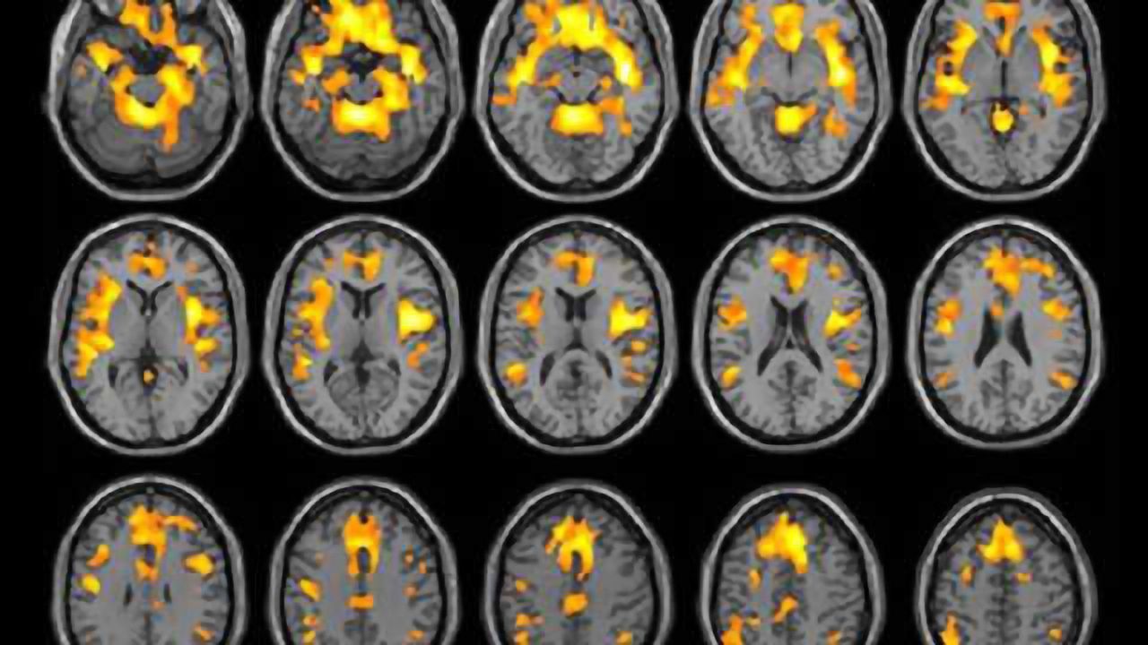 Substance abuse reduces brain volume in women but not men