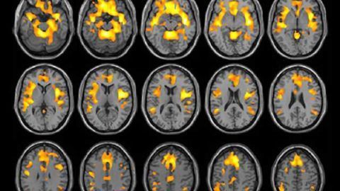 Substance abuse reduces brain volume in women but not men