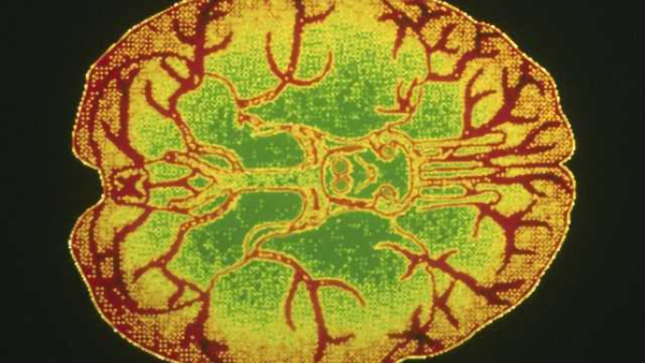 New treatment for severe depression with far fewer side effects