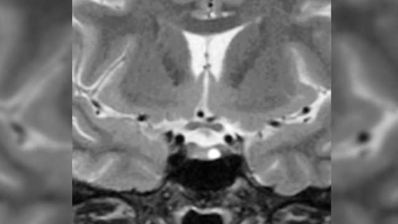 Narrowing in on pituitary tumors