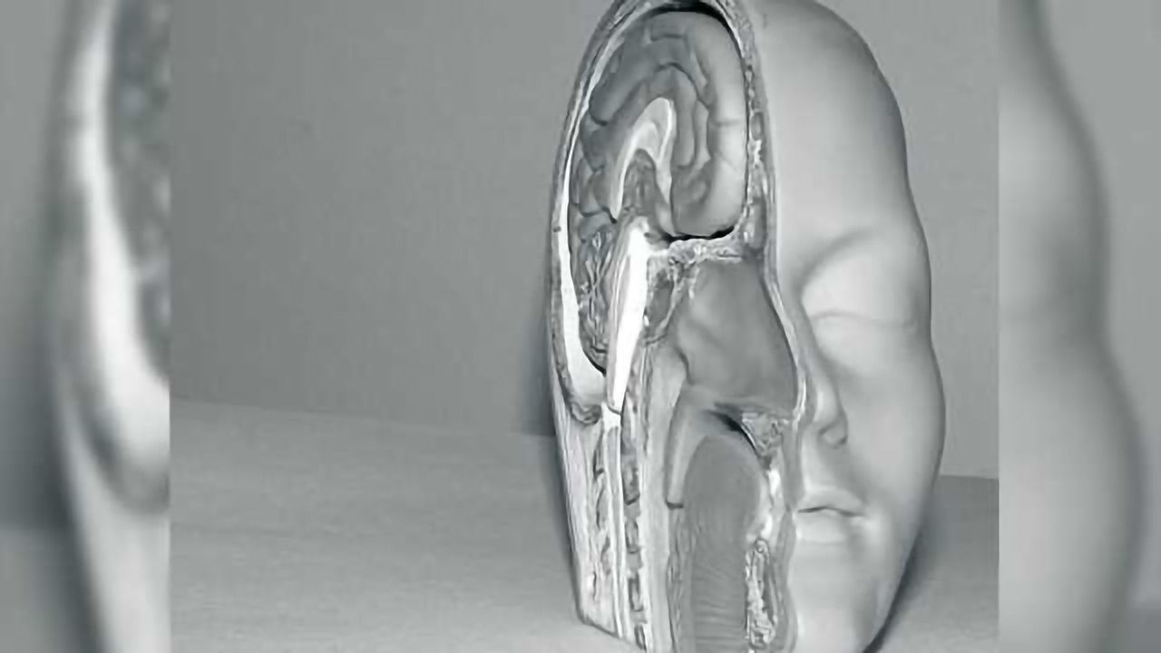 Insulin resistance, glucose uptake in the brain in adults at risk for Alzheimer's