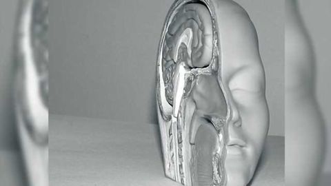 Insulin resistance, glucose uptake in the brain in adults at risk for Alzheimer's