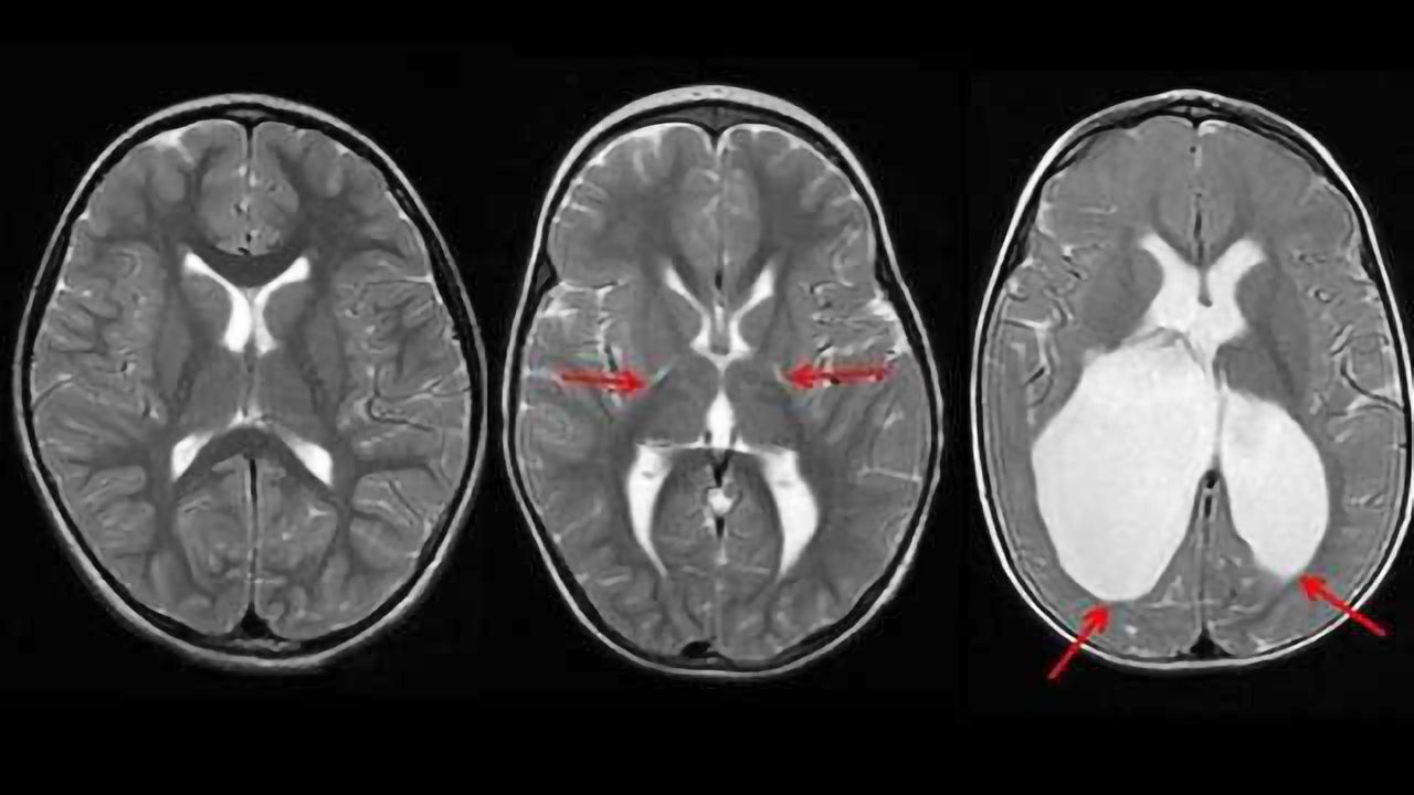 Study sheds surprising light on the causes of cerebral palsy