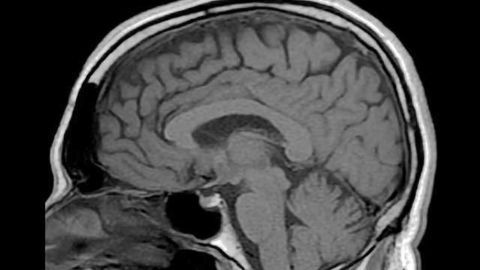 Understanding molecular mechanism leading to addiction in humans