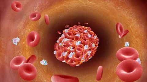 Stroke therapy put to the test in rigorous preclinical study