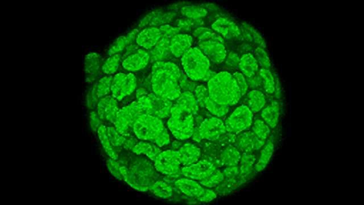 Scientists report explanation for protein clumps in autopsy brain cells of ALS patients