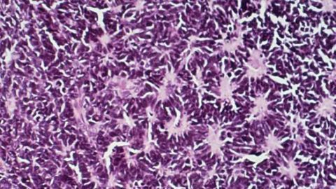 Common class of 'channel blocking' drugs may find a role in cancer therapy