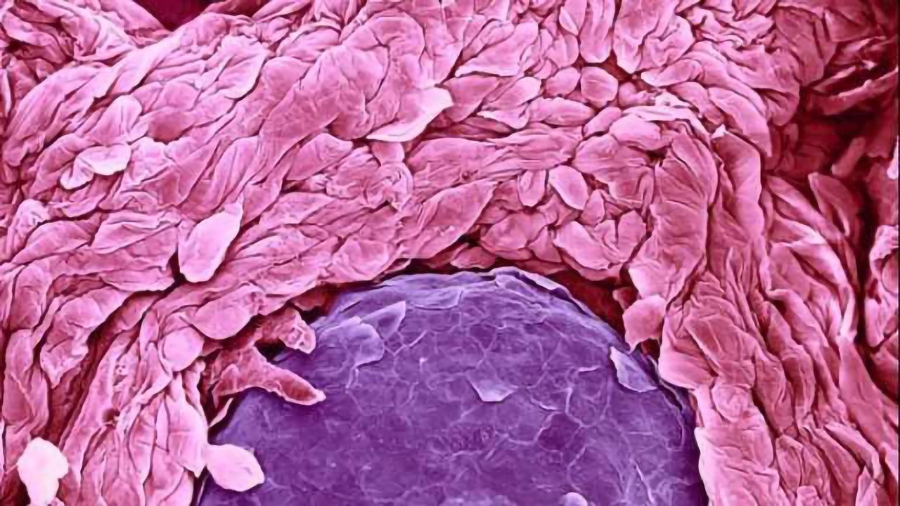 Study finds psoriasis patients have increased depression risk
