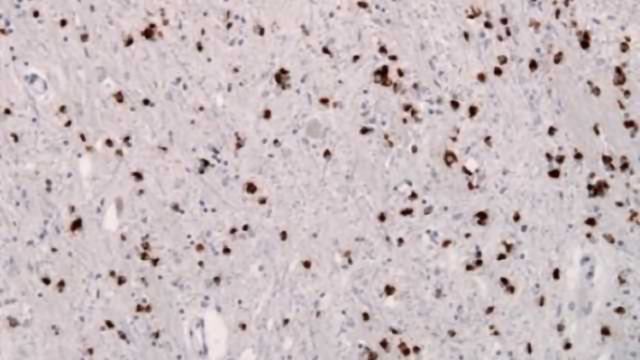 New type of prion may cause, transmit neurodegeneration