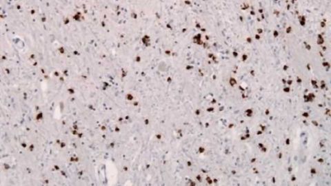 New type of prion may cause, transmit neurodegeneration