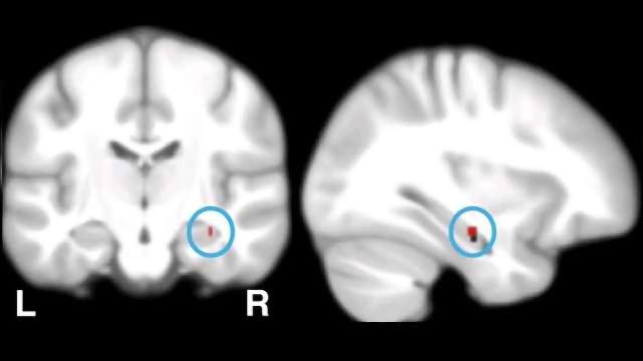 Tracking down the causes of Alzheimer's