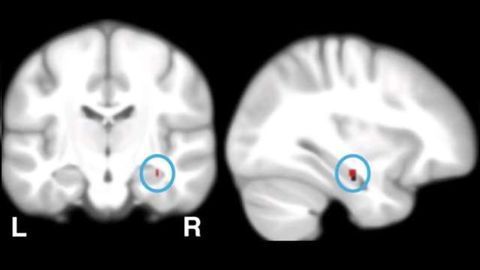 Tracking down the causes of Alzheimer's