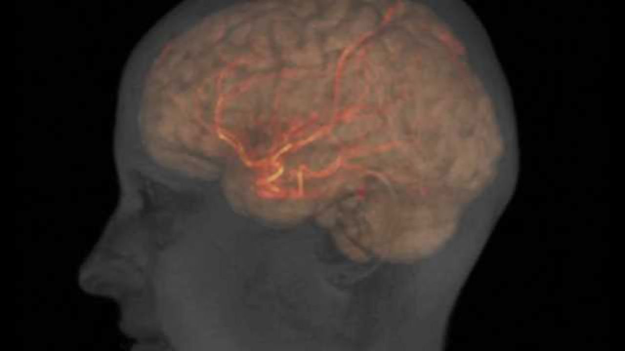 Brain damage during stroke may point to source of addiction