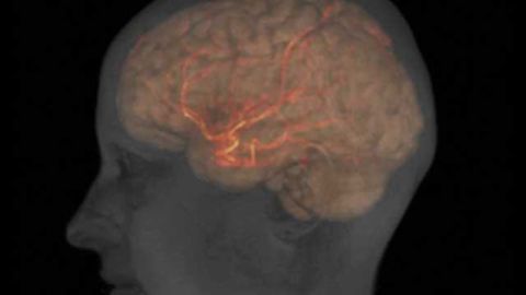 Brain damage during stroke may point to source of addiction