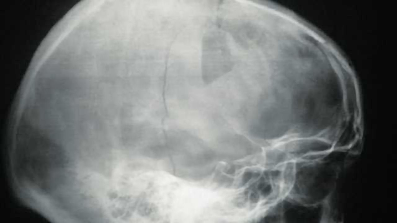 New rule to help identify fractures in young children with head trauma