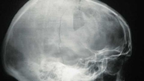 New rule to help identify fractures in young children with head trauma