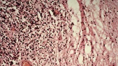 New drugs could stop the growth of drug-resistant childhood tumors