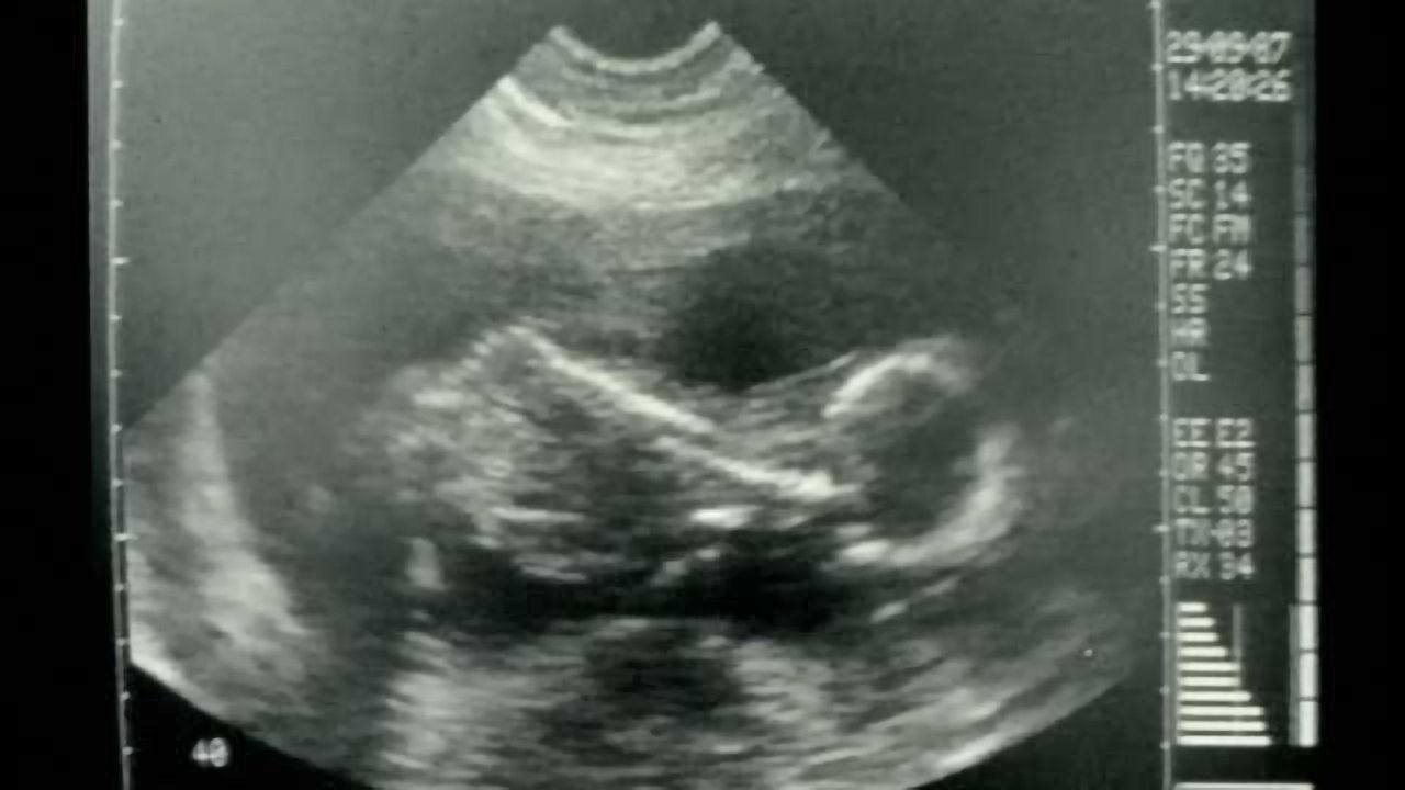 Scan may identify best candidates for fetal spina bifida surgery