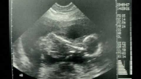 Scan may identify best candidates for fetal spina bifida surgery