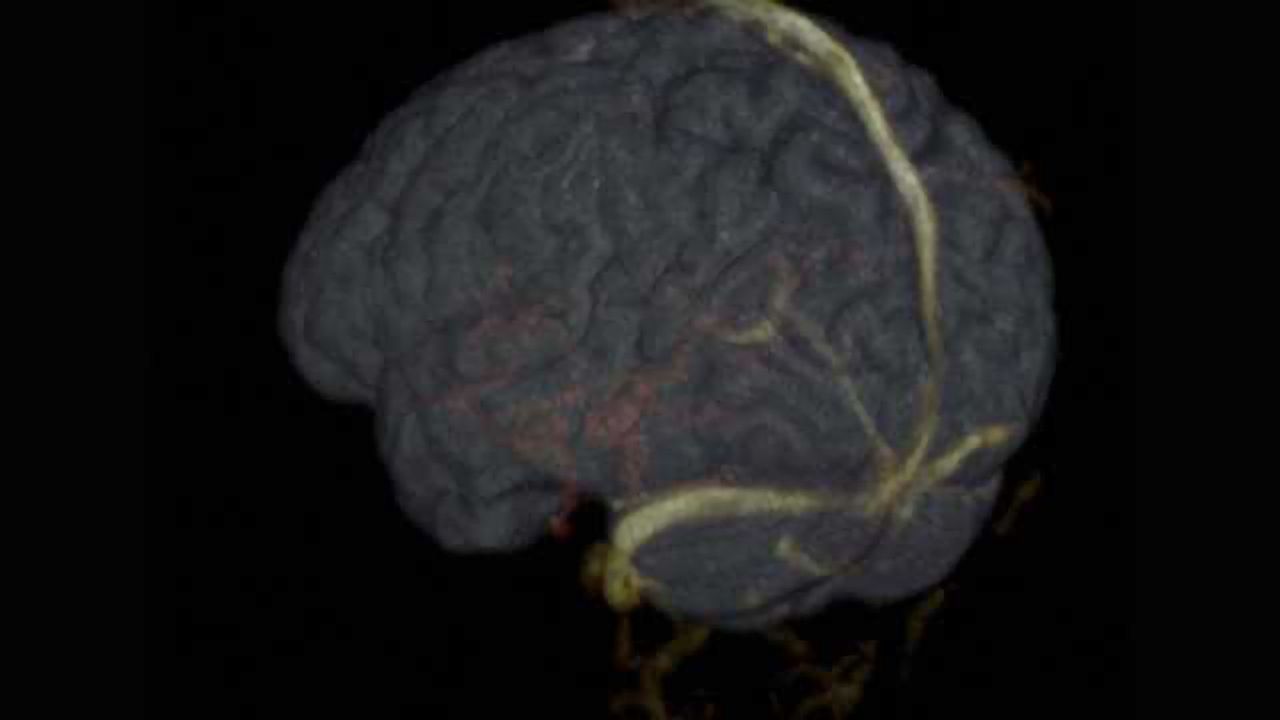 Researchers discover new method to measure artery stiffness in the human brain