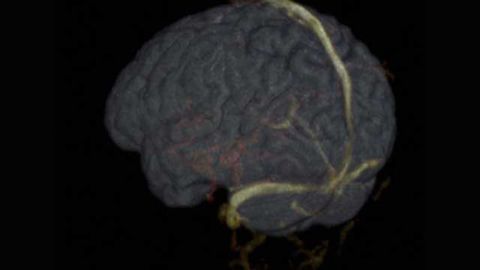 Researchers discover new method to measure artery stiffness in the human brain