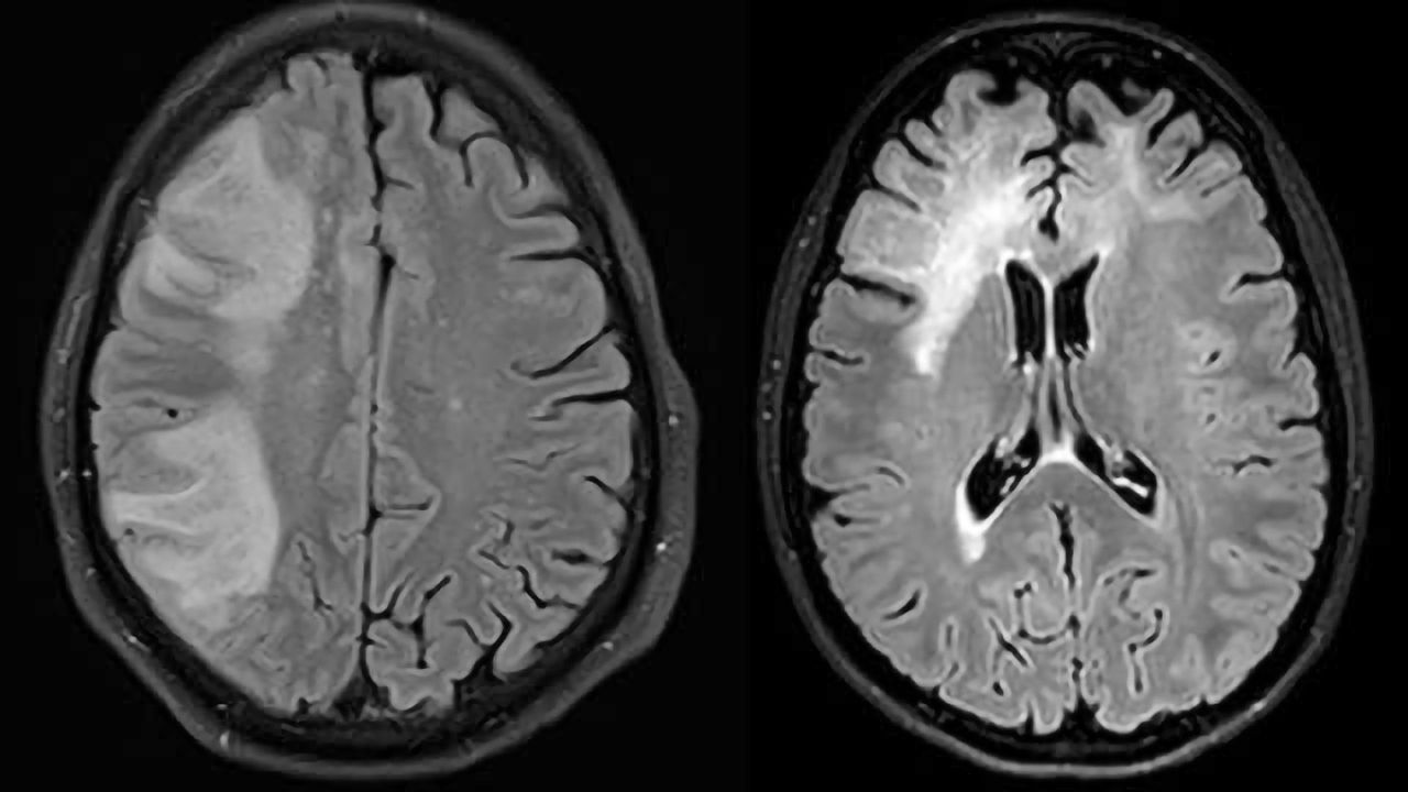 Vaccination on the horizon for severe viral infection of the brain