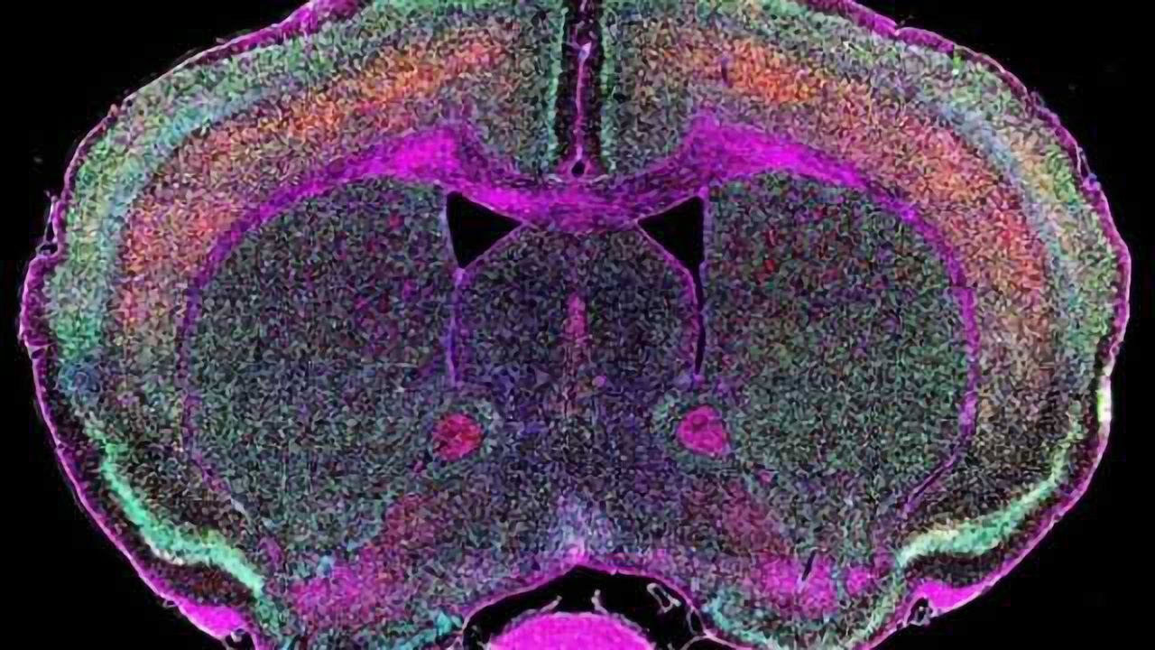 Dormant viral genes may awaken to cause ALS