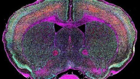 Dormant viral genes may awaken to cause ALS
