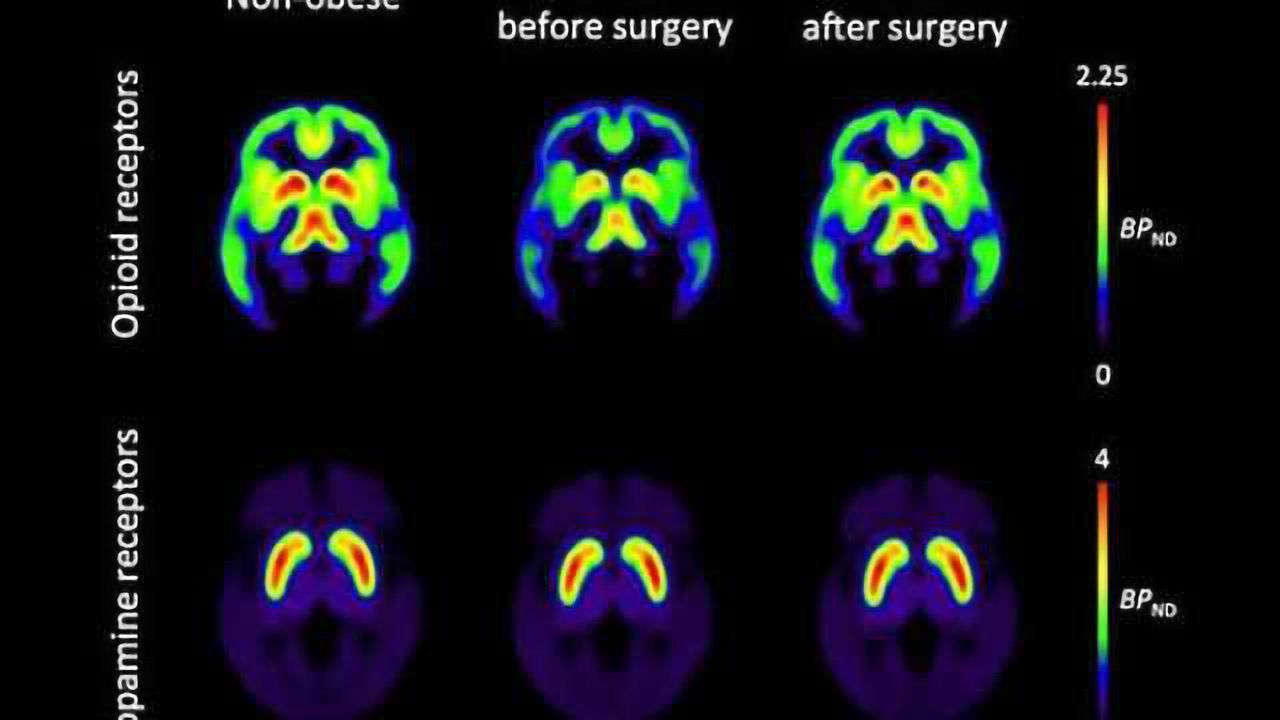 Obesity surgery normalizes brain opioids