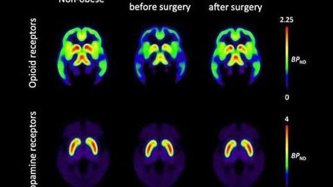 Obesity surgery normalizes brain opioids