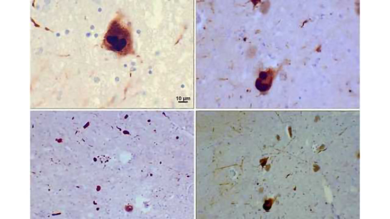 Stem cell treatment lessens impairments caused by dementia with Lewy bodies