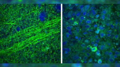Laser-based imaging tool could increase accuracy, safety of brain tumor surgery