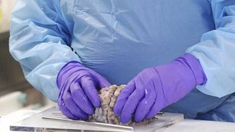 New technique permits cell-specific examination of proteins in alzheimer's disease brain tissue